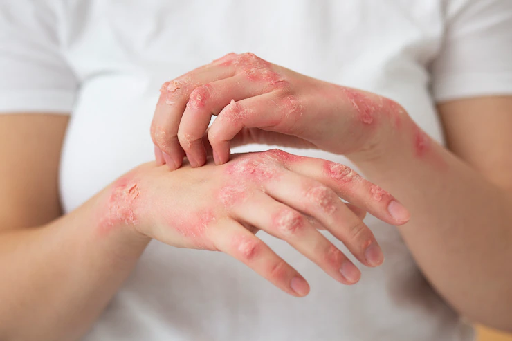 hands-patient-suffering-from-psoriasis