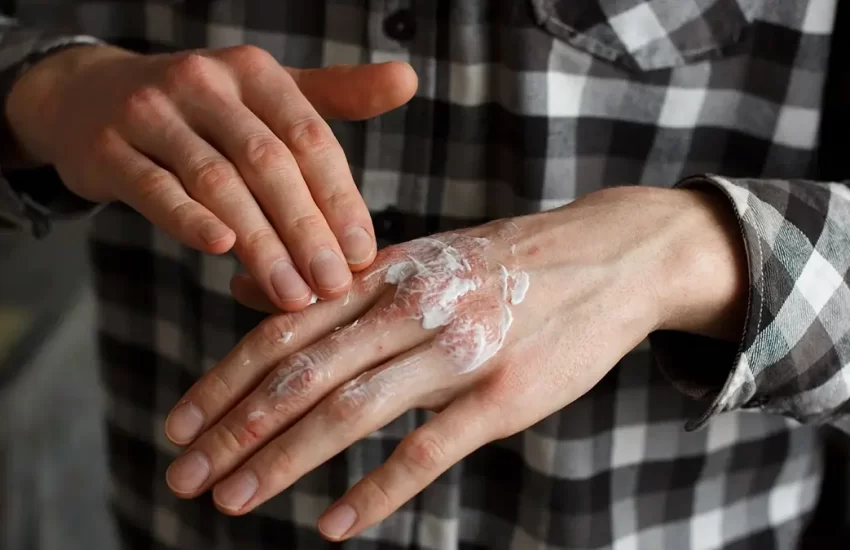 Best Creams for Psoriasis Symptoms